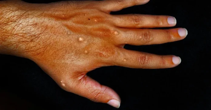 Asia tackles new monkeypox strain escalation