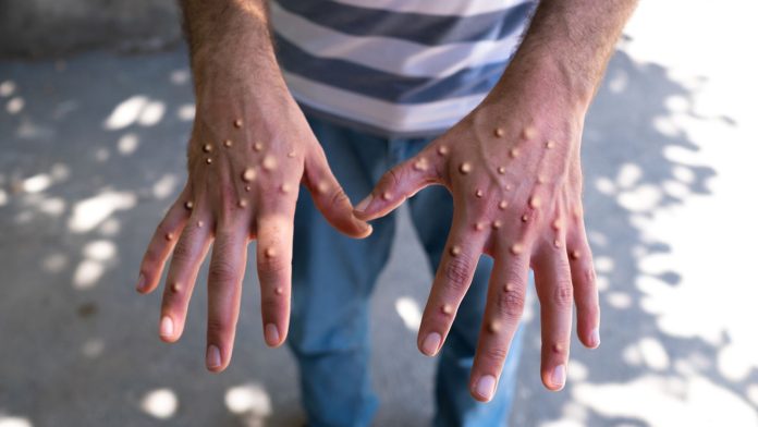 UK detects first case of Clade Ib monkeypox